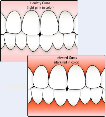 gums