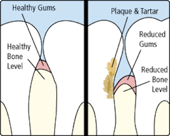 gums2